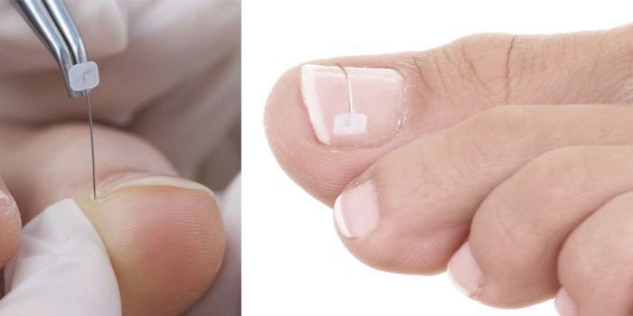 Fisiolution-podologia-COMBIPED-unas-encarnadas-nuevo-servicio-1-1